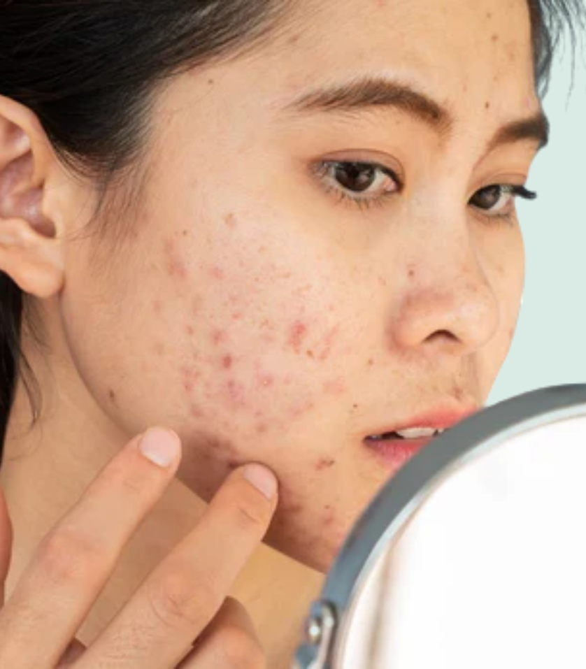 Causes of Acne