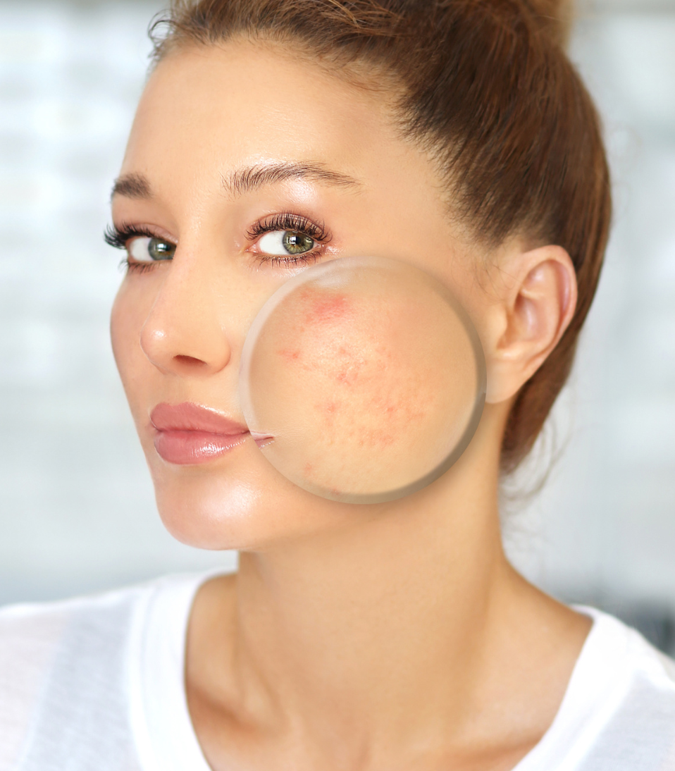 Causes of Acne and Sensitive Skin