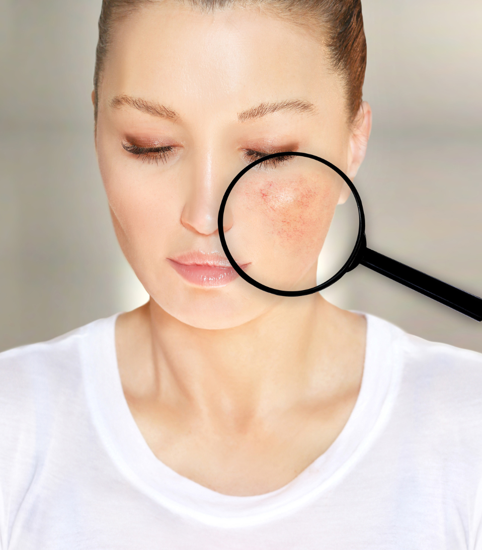 rosacea flare-ups