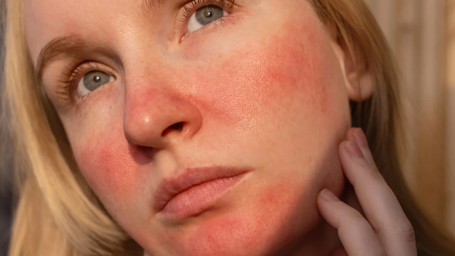 8 Rosacea Myths vs. Facts