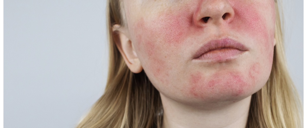 How to Calm Down Rosacea Fast