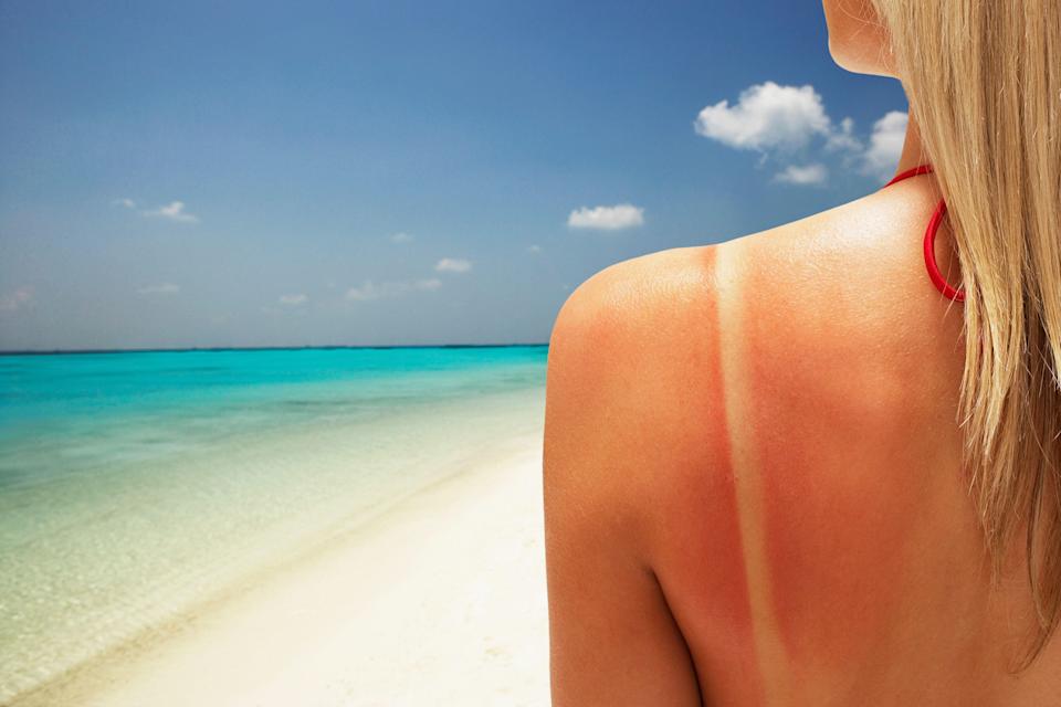 sunburn natural ways to treat it