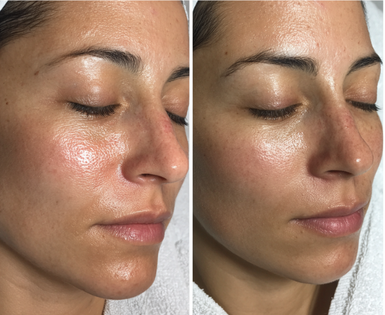 My skin is sensitive and breakout easily, I’ve tried everything, after 3 weeks, I see a huge difference!